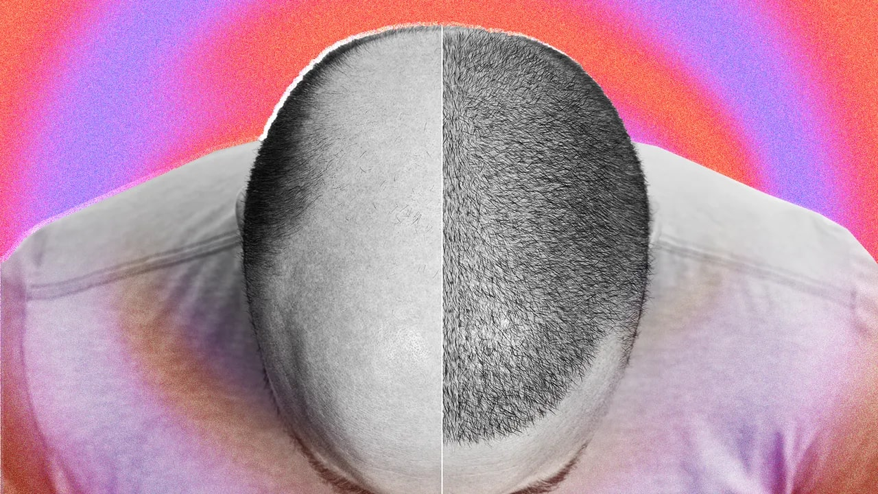 TikTok'ta Saç Ekim Sürecini Paylaşan Erkekler